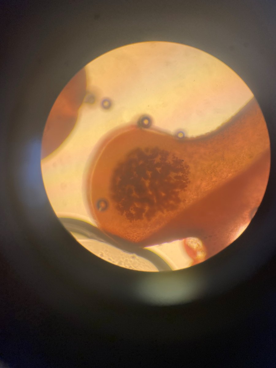 A specimen seen through a microscope eyepiece: an orange-red tissue with a dense cluster of dark round bodies at its center